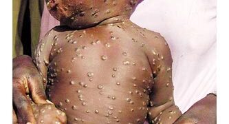 En ciernes la viruela del mono