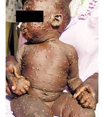 En ciernes la viruela del mono