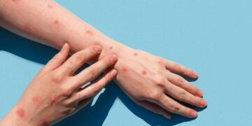 Segundo caso de viruela del mono