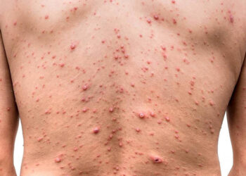 Incontenible la pandemia del mono