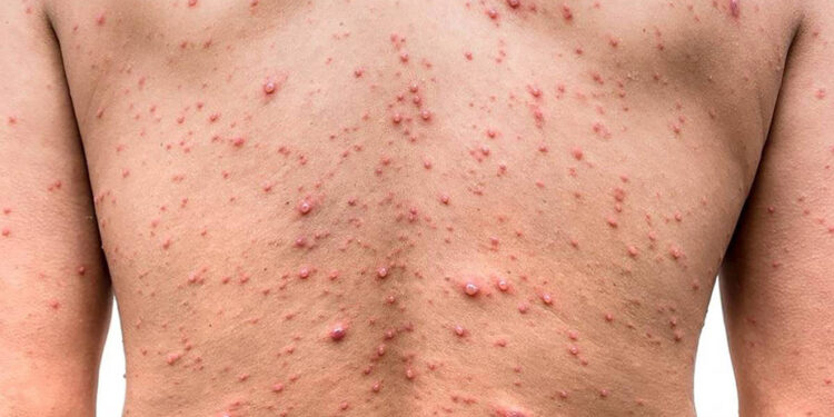 Incontenible la pandemia del mono