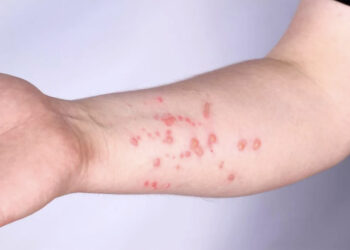 Virus del mono, lo que faltaba