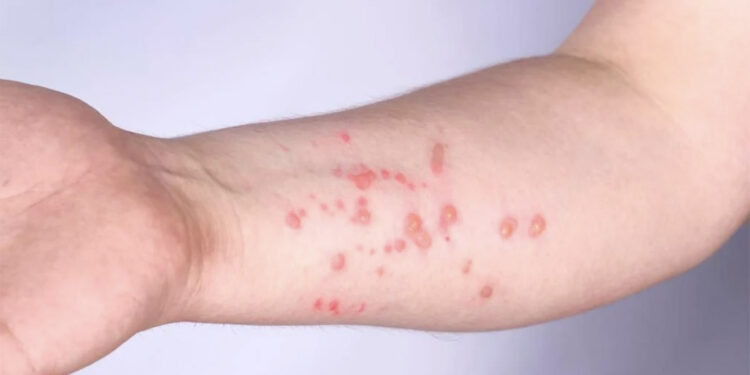 Virus del mono, lo que faltaba