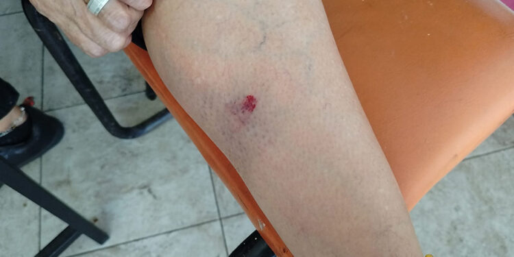 Profesora herida al explotar petardo