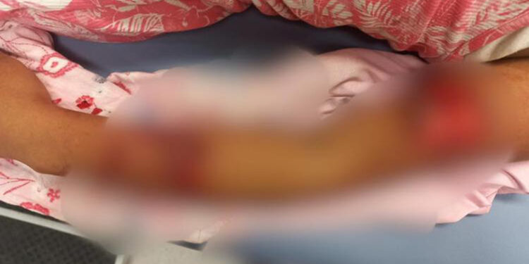 Le despedaza el brazo un Pitbull