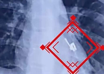 Se tragó el cursor de un ziper
