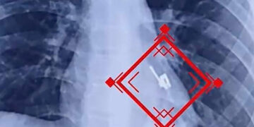 Se tragó el cursor de un ziper