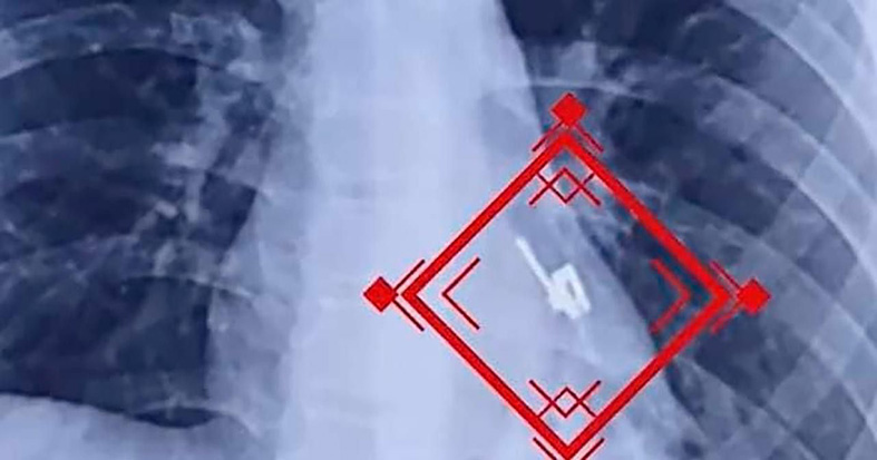 Se tragó el cursor de un ziper