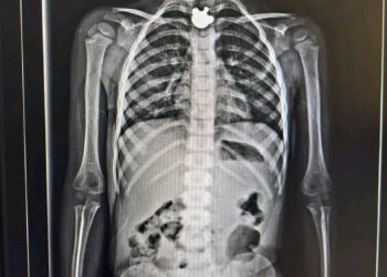 Niña tragó una figura de metal