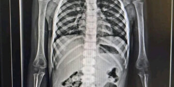 Niña tragó una figura de metal