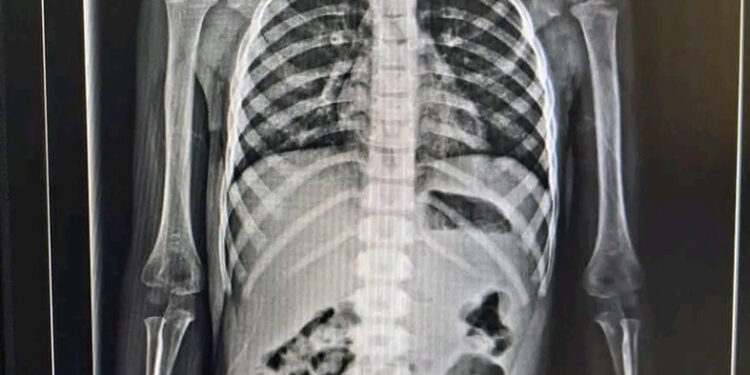 Niña tragó una figura de metal